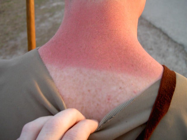 sunburn